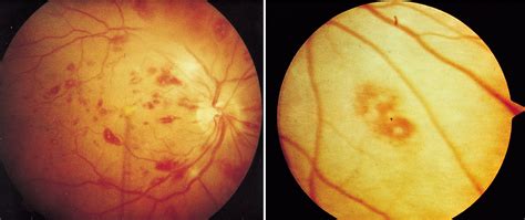 Infective Endocarditis Causes Signs Symptoms Diagnosis And Treatment