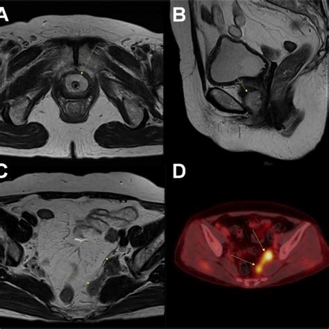 Pelvic Magnetic Resonance Imaging Mri Showing A 3 5 Cm Enhancing Download Scientific Diagram