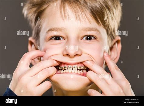 Studio Portrait Of White Boy With Braces Stock Photo Alamy