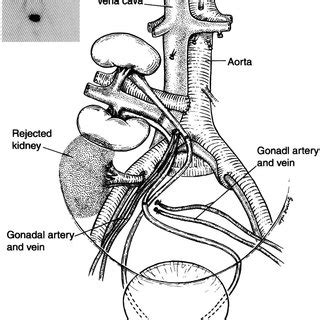 Transposition Of Left Ureter To Right Accompanying Gonadal Vessels