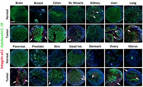 Expression Of Integrin In Array Sections From Normal And Tumor