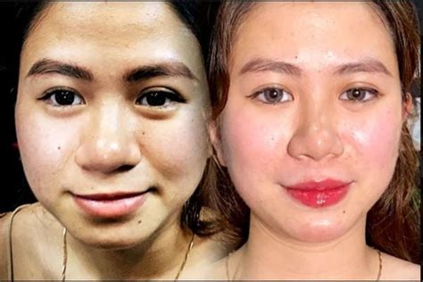 Tiêm Filler Làm Đầy Hốc Mắt Giải Pháp Tối Ưu Cho Vẻ Ngoài Tươi Trẻ