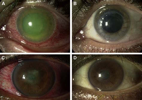 Acanthamoeba Sclerokeratitis Ophthalmology