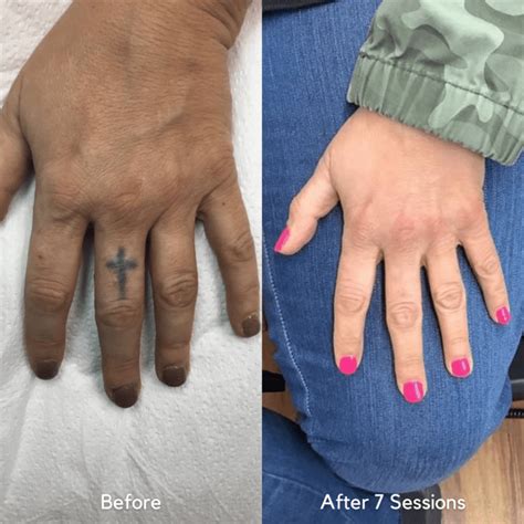 Vol 2 Best Of 2021 Before After Tattoo Removal Results Removery