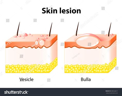 Vesicle Bulla Skin Lesion Stock Illustration 386526817 | Shutterstock