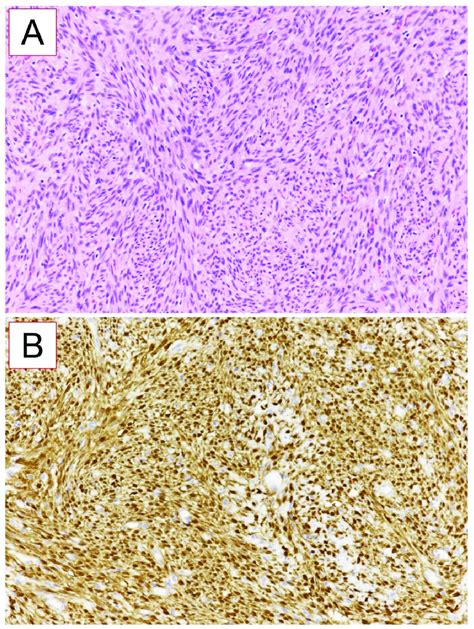 Histological Examination Of Glomangiopericytoma He Coloration A And