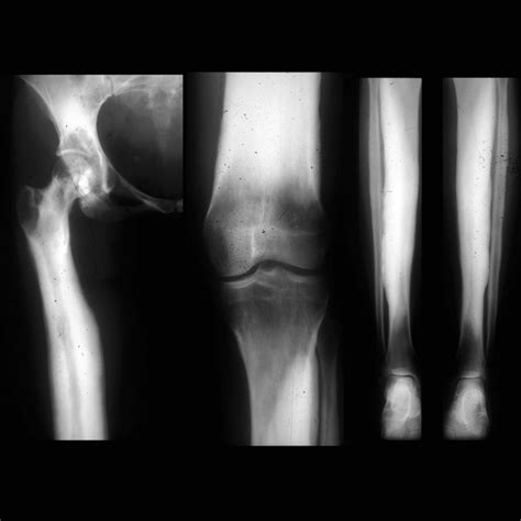 Teenager with leg pain | Pediatric Radiology Case | Pediatric Imaging ...