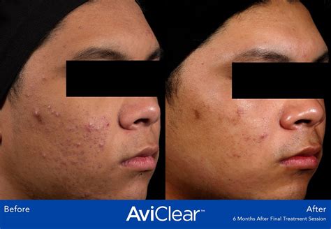 AviClear Acne Treatment | U.S. Dermatology Partners