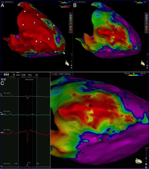 Epicardial Voltage Map During Sinus Rhythm Showing Extensive Scarring