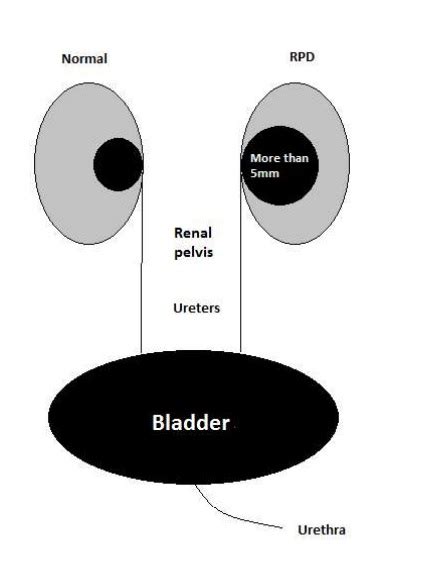 Renal Pelvis Dilatation Rpd Public Health Wales