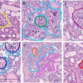 Annotated Images Of Glomeruli And Tubules In Pathological Findings In