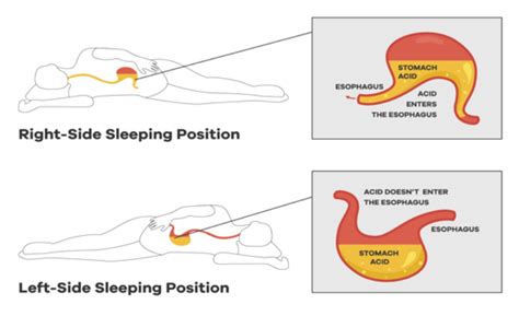 Pay Attention To Your Sleeping Position Nsc Medical