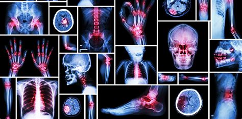 What Are the Different Types of Arthritis? - HealthLiving.today