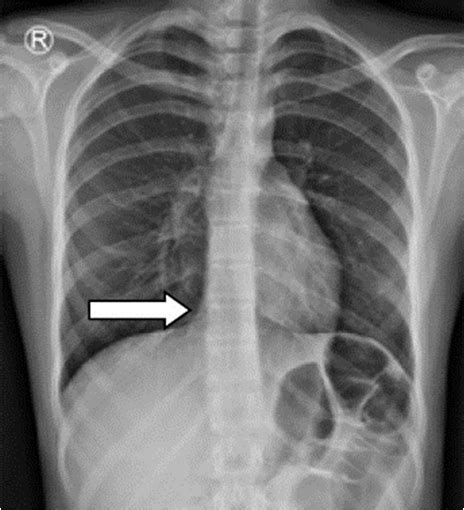 Chest X Ray Normal Cardiac Silhouette And Normal Pulmonary Download Scientific Diagram