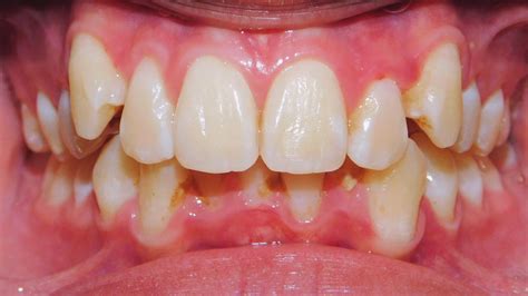 Class Ii Division 1 Malocclusion Excessive Overjet Deep Overbite Case Gallery