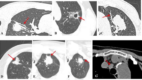 Frontiers Ct Radiomics Model Combined With Clinical And Radiographic Features For