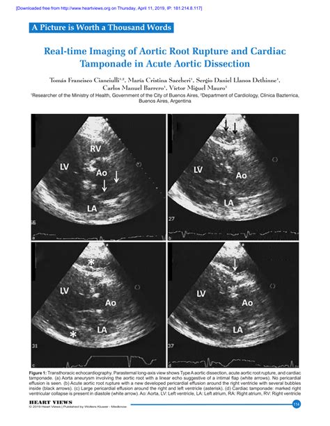 Pdf Real Time Imaging Of Aortic Root Rupture And Cardiac Tamponade In