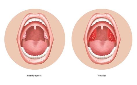 10 Causes and Symptoms of Tonsillitis