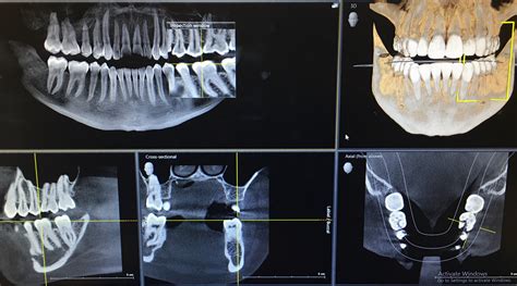 3D X-Rays Changing Dentistry — Bloomington Dental