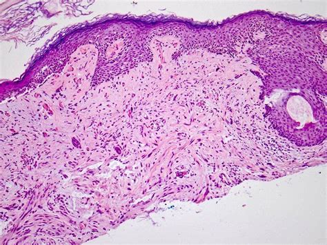 Diagnostic techniques for desmoplastic melanoma