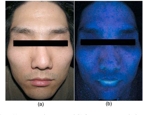 Figure 5 From Analysis Of Facial Sebum Distribution Using A Digital