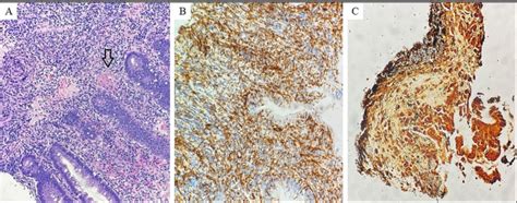 Rectal Biopsy Histology A Hematoxylin And Eosin Stain Demonstrating Download Scientific