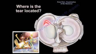 Knee Pain Meniscus Tear Everything You Need To Know Dr Nabil Ebraheim Youtube