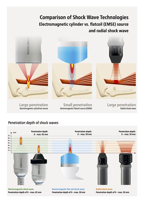 Shock Wave Therapy New — Dr Nick Chiropractic Soft Tissue Therapy