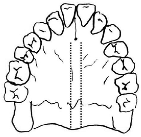 Figure 1 From Overview Of Surgical Treatment For Maxillary Constriction