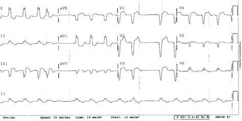 Electrocardiogram Showing St Elevations In Leads Ii Ii And Avf Download Scientific Diagram