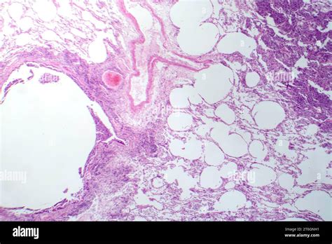 Photomicrograph Of Interstitial Pneumonia Showing Inflammation And