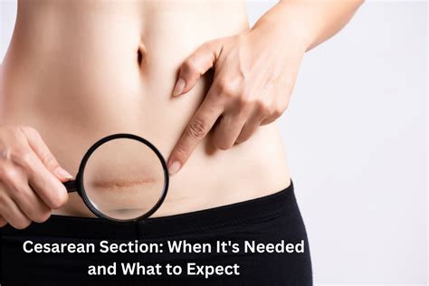 Cesarean Section When It S Needed And What To Expect