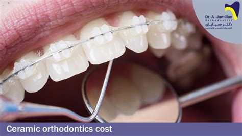 Ceramic Orthodontics Cost Dr Jamilian