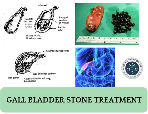 Gallstone Size Chart A Visual Reference Of Charts Chart Master