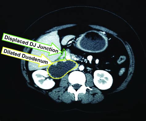 Malrotation Ct Scan