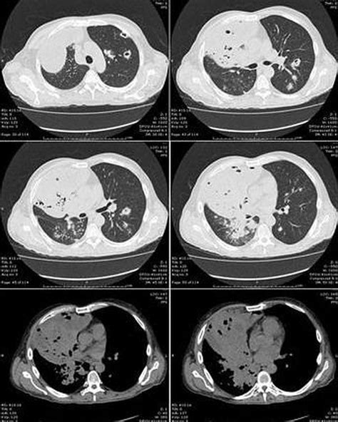 Pulmonary Nocardiosis - MEDizzy