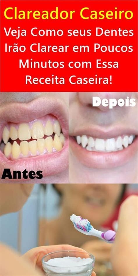 Clareador Caseiro Veja Como Seus Dentes Ir O Clarear Em Poucos