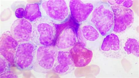 Leucemia Mieloide Cr Nica C Mo Es La Enfermedad Que Le Diagnosticaron