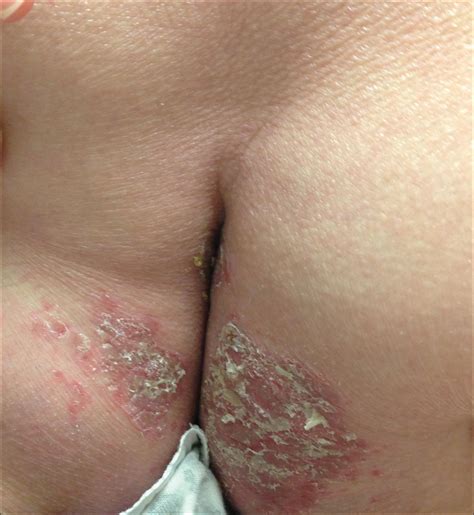 Acrodermatitis Enteropathica From Zinc Deficient Total Parenteral