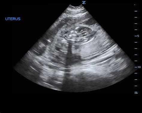 Sonography 3rd Trimester And Placenta Assessment Protocols And Interpretation Statpearls