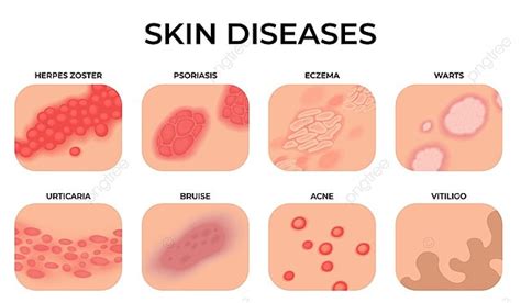 Skin Disease Template Download on Pngtree