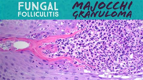 Majocchi Granuloma Fungal Folliculitis By Dermatophyte Tinea Ringworm