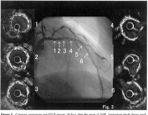 Figure 3 from A case report of late coronary stent thrombosis ...