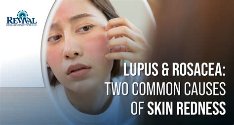 Lupus And Rosacea Two Common Causes Of Skin Redness