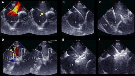 Use Of Intracardiac Echocardiography In Interventional Cardiology