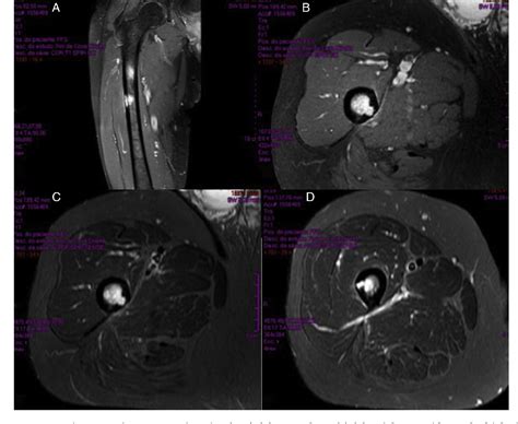 Figure 3 From Primary Angiosarcoma Of The Femur In A Patient With