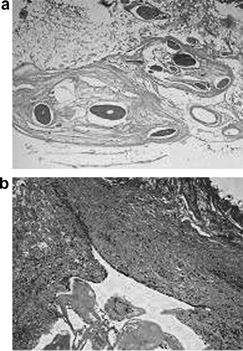 Radiologically Atypical Congenital Posterior Fossa Dermoid Cyst