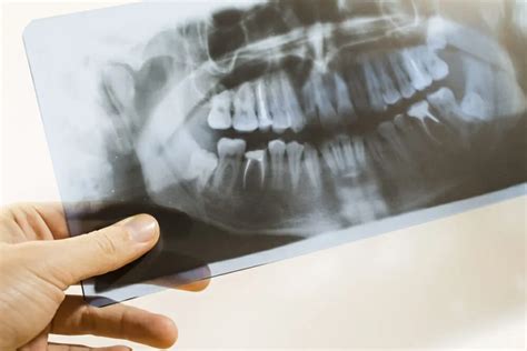 Are Dental X Rays Safe Why Do I Need Dental X Rays