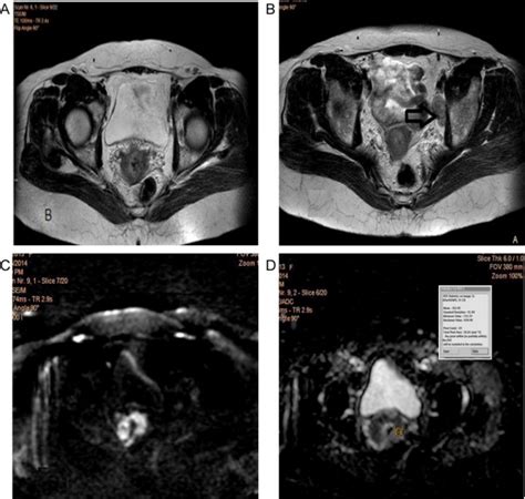 53years Old With Cancer Cervix Figo Stage Iib A Axial T2wi Shows Download Scientific Diagram