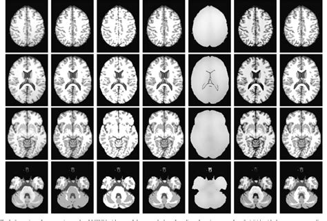 Figure 1 From Segmentation Of Longitudinal Brain MR Images Using Bias